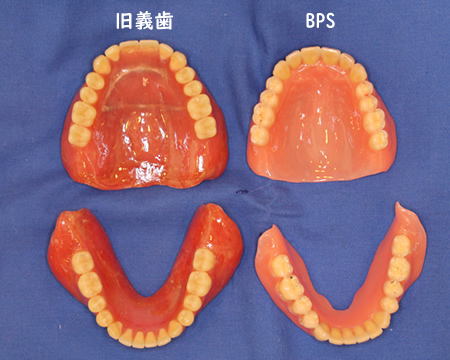 BPS 入れ歯を完成