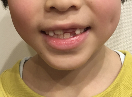 こどもの歯並び